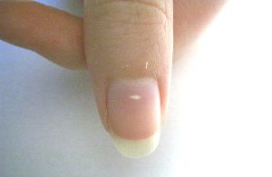 ¿Qué son las manchas blancas en las uñas?