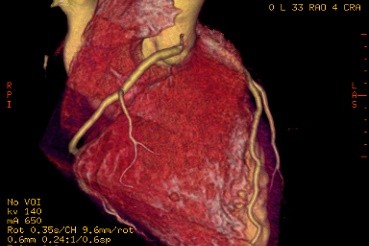 Tomografía Cardíaca Multislice: Ventajas para Prevenir
