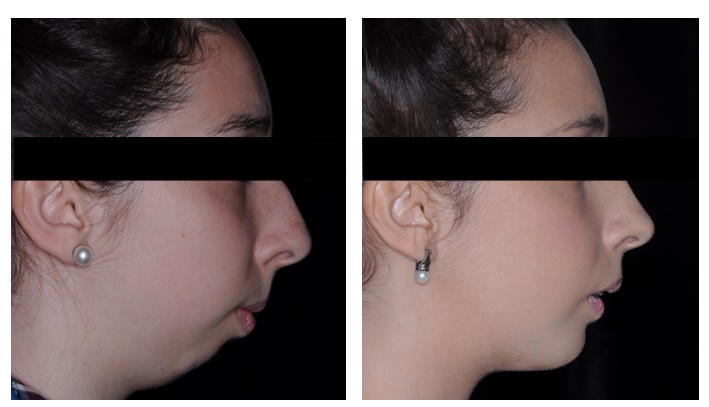 Cirugía mandíbula de Perfil: antes y después 2