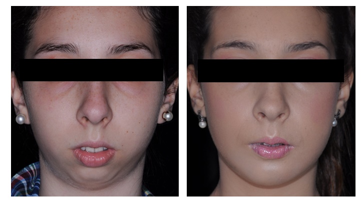 Cirugía mandíbula: antes y después