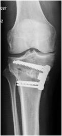 Osteotomía de Apertura de Rodilla 10