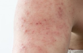 Dermatitis Atópica