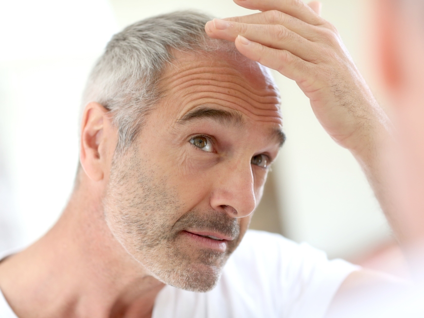 ¿Qué es la Alopecia Areata?
