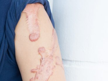 Cicatrices Queloides: Tratamientos eficaces y rápidos.
