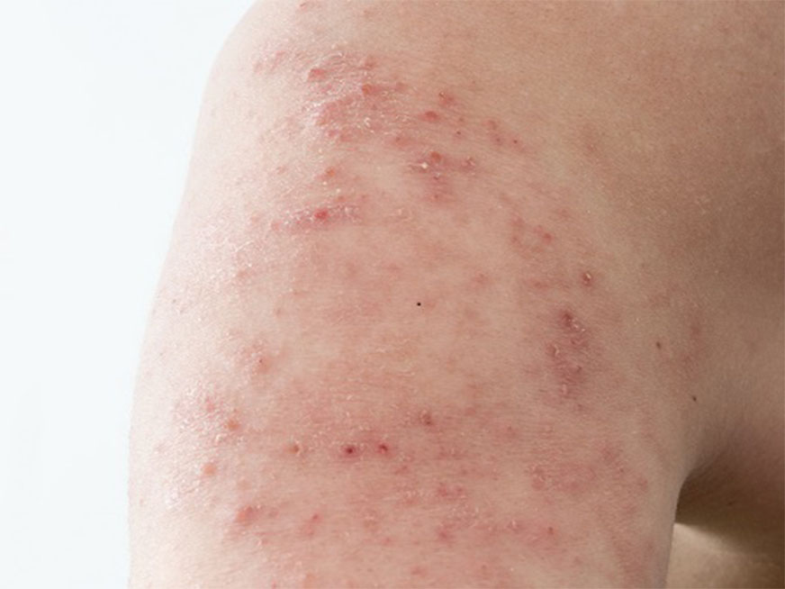 Herpes zoster, la famosa “culebrilla” en la piel