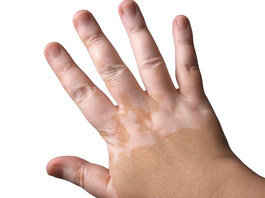 Vitiligo: Diagnóstico y tratamiento