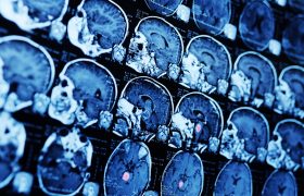Tratamientos de los tumores cerebrales: una mirada holística