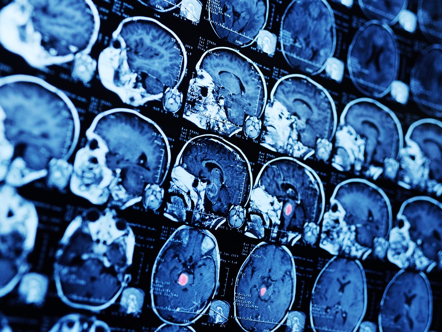Tratamientos de los tumores cerebrales: una mirada holística