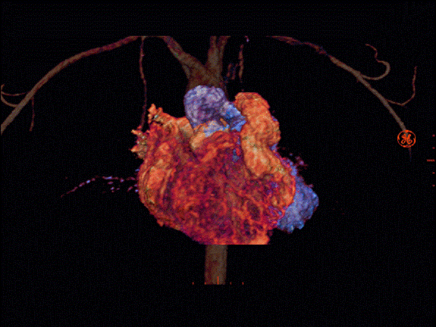 Utilidad de la Secuencia 3D en Cardiopatías Congénitas.
