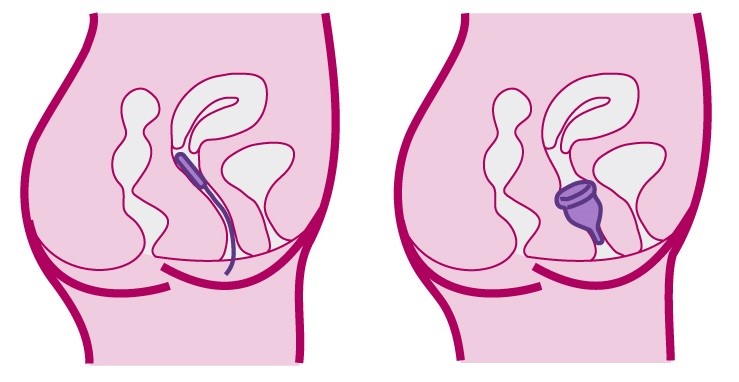 Copa menstrual o no? | Ginecología | Grupo Gamma