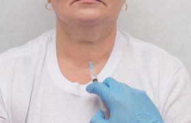 Punción con aguja fina de nódulos tiroideos | Grupo Gamma