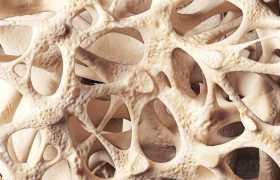Osteoporosis. ¿De qué hablamos? | Grupo Gamma