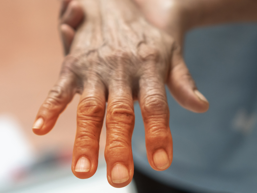 Artritis Psoriásica ¿De qué se trata?