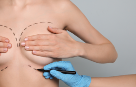 Qué es la Hipertrofia mamaria y la cirugía de Reducción mamaria