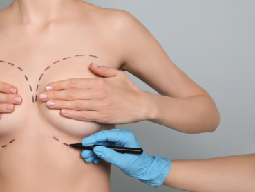 Qué es la Hipertrofia mamaria y la cirugía de Reducción mamaria
